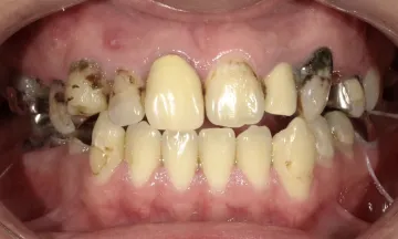 治療前の口内の画像